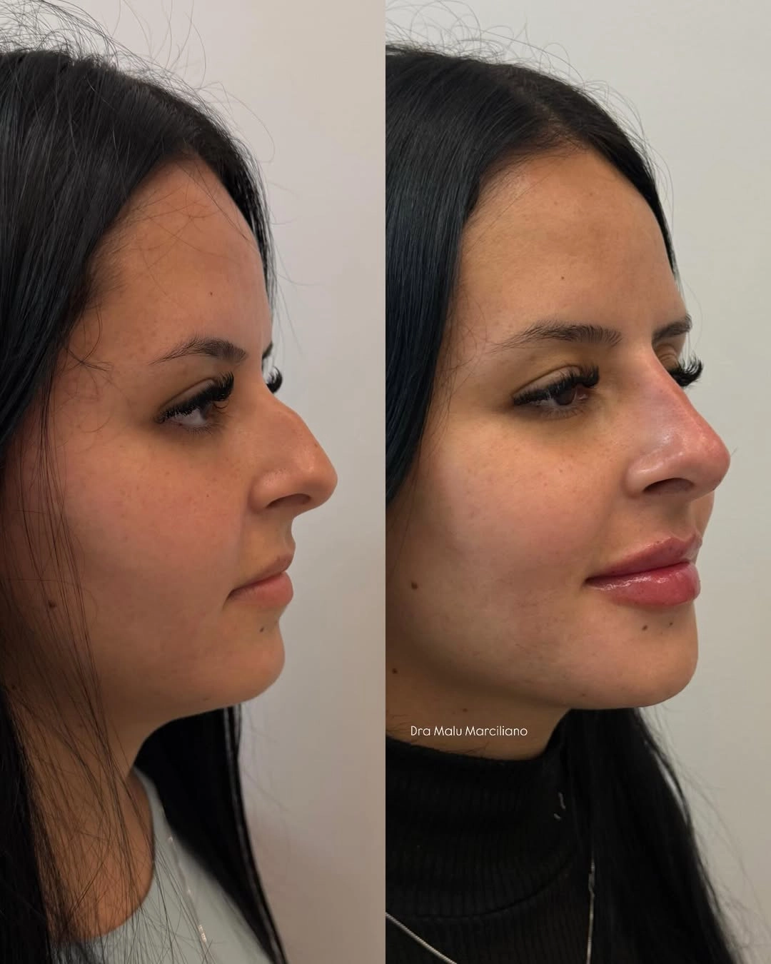 Resultado Antes e Depois de Harmonização de Perfil, Nariz e Lábios