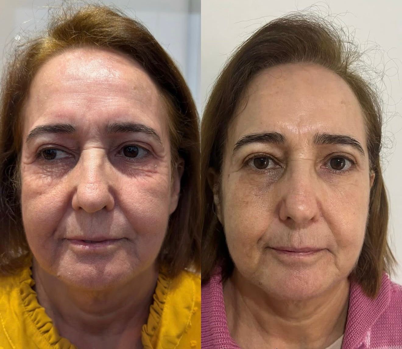 Resultado Antes e Depois com Bioestimuladores e PDRN